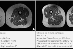 Representative axial T1-weighted spin-echo thigh MRI scans in (A) a 61-year-old female participant and (B) a 62-year-old female participant. Both participants were of similar age and body mass index (BMI, calculated as weight in kilograms divided by height in meters squared). Both had Physical Activity Scale for the Elderly scores above the mean score in the study. According to the World Health Organization definition, the participant in B qualified as having abdominal obesity (abdominal circumference ≥ 88 cm). Abdominal circumference is a measure of central obesity that captures fat distribution and serves as an indicator of cardiometabolic health. Compared with the participant in A, the participant in B had a higher proportion of ultra-processed food (UPF) in their diet (87.1% vs 29.5%) and exhibited fattier thigh muscles bilaterally, with Goutallier grade (GG) for all thigh muscles summing to 25 for the participant in A and 38 for the participant in B.
