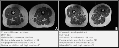 Representative axial T1-weighted spin-echo thigh MRI scans in (A) a 61-year-old female participant and (B) a 62-year-old female participant. Both participants were of similar age and body mass index (BMI, calculated as weight in kilograms divided by height in meters squared). Both had Physical Activity Scale for the Elderly scores above the mean score in the study. According to the World Health Organization definition, the participant in B qualified as having abdominal obesity (abdominal circumference ≥ 88 cm). Abdominal circumference is a measure of central obesity that captures fat distribution and serves as an indicator of cardiometabolic health. Compared with the participant in A, the participant in B had a higher proportion of ultra-processed food (UPF) in their diet (87.1% vs 29.5%) and exhibited fattier thigh muscles bilaterally, with Goutallier grade (GG) for all thigh muscles summing to 25 for the participant in A and 38 for the participant in B.