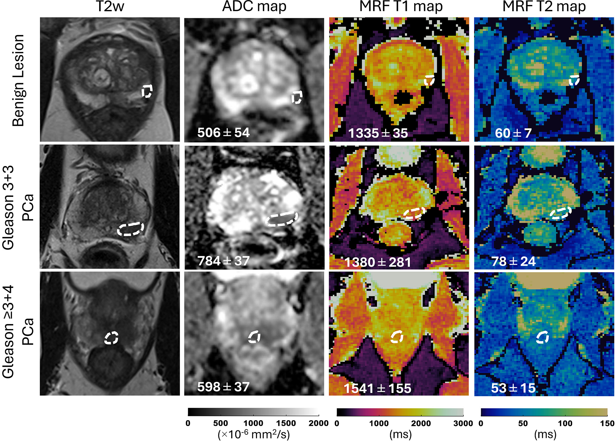Representative T2-weighted (T2w) images, apparent diffusion coefficient (ADC) maps, and MR fingerprinting (MRF)-derived T1 and T2 maps obtained from three participants with different histologic types of prostatic lesions. Lesions are circled with dashed lines. Mean values with standard deviations for ADC, T1, and T2 are shown at the bottom of the images. PCa = prostate cancer.