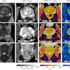Representative T2-weighted (T2w) images, apparent diffusion coefficient (ADC) maps, and MR fingerprinting (MRF)-derived T1 and T2 maps obtained from three participants with different histologic types of prostatic lesions. Lesions are circled with dashed lines. Mean values with standard deviations for ADC, T1, and T2 are shown at the bottom of the images. PCa = prostate cancer.