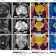 Representative T2-weighted (T2w) images, apparent diffusion coefficient (ADC) maps, and MR fingerprinting (MRF)-derived T1 and T2 maps obtained from three participants with different histologic types of prostatic lesions. Lesions are circled with dashed lines. Mean values with standard deviations for ADC, T1, and T2 are shown at the bottom of the images. PCa = prostate cancer.
