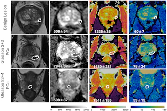 Representative T2-weighted (T2w) images, apparent diffusion coefficient (ADC) maps, and MR fingerprinting (MRF)-derived T1 and T2 maps obtained from three participants with different histologic types of prostatic lesions. Lesions are circled with dashed lines. Mean values with standard deviations for ADC, T1, and T2 are shown at the bottom of the images. PCa = prostate cancer.