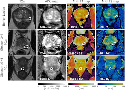 Representative T2-weighted (T2w) images, apparent diffusion coefficient (ADC) maps, and MR fingerprinting (MRF)-derived T1 and T2 maps obtained from three participants with different histologic types of prostatic lesions. Lesions are circled with dashed lines. Mean values with standard deviations for ADC, T1, and T2 are shown at the bottom of the images. PCa = prostate cancer.