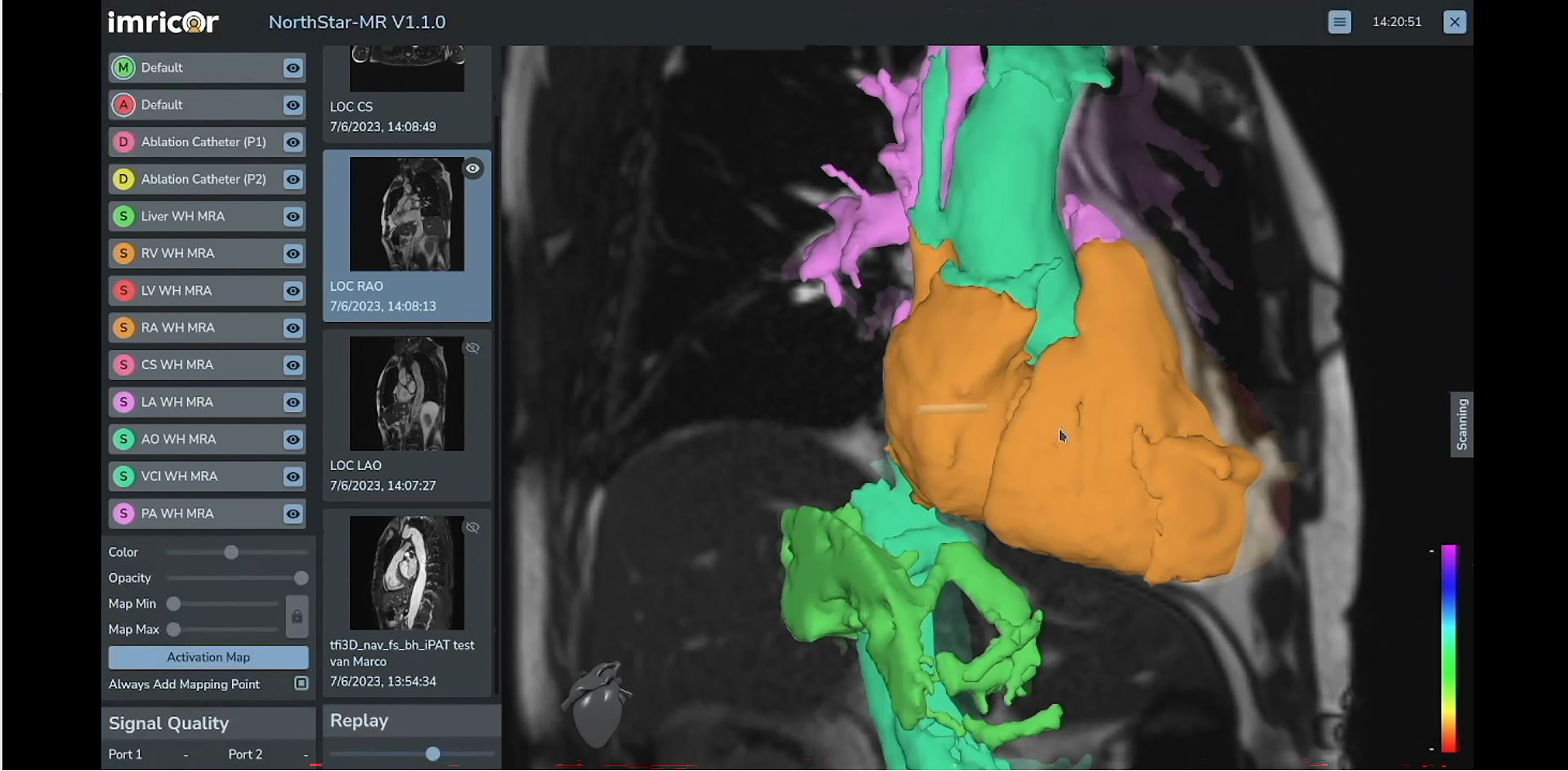 A screenshot of Imricor's Northstar Mapping System.