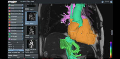 A screenshot of Imricor's Northstar Mapping System.