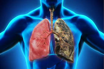 Lung Cancer