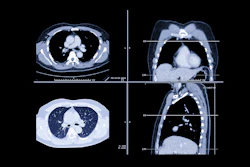 Lung Ct Images