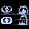 Lung Ct Images