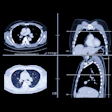 Lung Ct Images