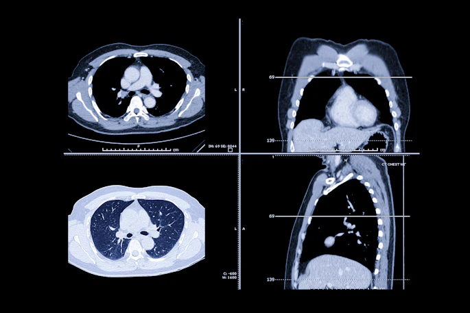 Lung Ct Images