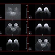 Mri Breast Cancer