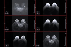 Mri Breast Cancer