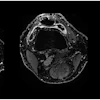 Contrast-enhanced T1 weSPGR images of the knee of a patient from the GAE group at the level of the suprapatellar recess. The baseline image (left) shows a marked synovial enhancement. There was no change one month after treatment (middle image) and four months after treatment (right image).
