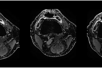 Contrast-enhanced T1 weSPGR images of the knee of a patient from the GAE group at the level of the suprapatellar recess. The baseline image (left) shows a marked synovial enhancement. There was no change one month after treatment (middle image) and four months after treatment (right image).