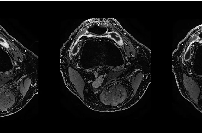 Contrast-enhanced T1 weSPGR images of the knee of a patient from the GAE group at the level of the suprapatellar recess. The baseline image (left) shows a marked synovial enhancement. There was no change one month after treatment (middle image) and four months after treatment (right image).