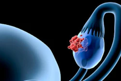 Ovarian Cancer Social