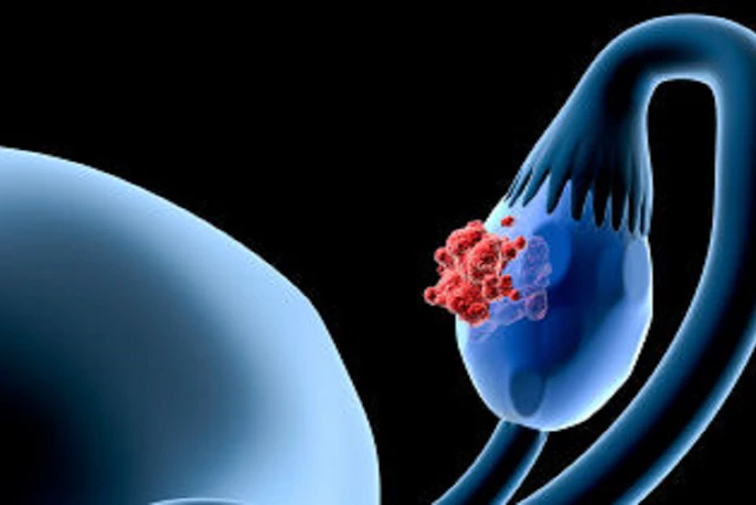 Ovarian Cancer Social