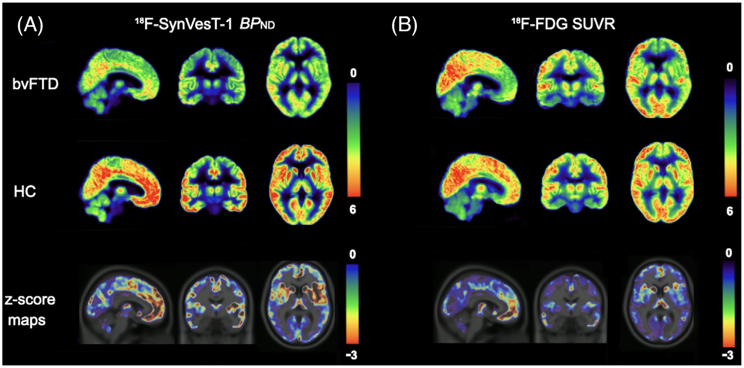 (A) Averaged parametric images of F-18 SynVesT-1 BPND values and (B) F-18 FDG SUVR (60&ndash;90 minutes) values overlaid on anatomical (T1) images in MNI space show group differences between behavioral variant frontotemporal dementia (top) and healthy controls (middle). The color scale represents (A) BPND and (B) SUVR values. On the bottom, average z-score maps were generated to visualize regional reductions in F-18 SynVesT-1 BPND and F-18 FDG SUVR in bvFTD relative to healthy controls. For each voxel, z-scores were calculated as z = (bvFTD&minus;meanHC )/SDHC. Negative z-scores indicate lower synaptic density or glucose metabolism in the bvFTD compared with controls in the regions. BPND, non-displaceable binding potential; bvFTD, behavioral variant frontotemporal dementia; F-18 FDG, F-18 fluorodeoxyglucose; MNI, Montreal Neurological Institute; SUVR, standardized uptake value ratio.