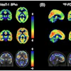 (A) Averaged parametric images of F-18 SynVesT-1 BPND values and (B) F-18 FDG SUVR (60–90 minutes) values overlaid on anatomical (T1) images in MNI space show group differences between behavioral variant frontotemporal dementia (top) and healthy controls (middle). The color scale represents (A) BPND and (B) SUVR values. On the bottom, average z-score maps were generated to visualize regional reductions in F-18 SynVesT-1 BPND and F-18 FDG SUVR in bvFTD relative to healthy controls. For each voxel, z-scores were calculated as z = (bvFTD−meanHC )/SDHC. Negative z-scores indicate lower synaptic density or glucose metabolism in the bvFTD compared with controls in the regions. BPND, non-displaceable binding potential; bvFTD, behavioral variant frontotemporal dementia; F-18 FDG, F-18 fluorodeoxyglucose; MNI, Montreal Neurological Institute; SUVR, standardized uptake value ratio.
