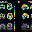 (A) Averaged parametric images of F-18 SynVesT-1 BPND values and (B) F-18 FDG SUVR (60–90 minutes) values overlaid on anatomical (T1) images in MNI space show group differences between behavioral variant frontotemporal dementia (top) and healthy controls (middle). The color scale represents (A) BPND and (B) SUVR values. On the bottom, average z-score maps were generated to visualize regional reductions in F-18 SynVesT-1 BPND and F-18 FDG SUVR in bvFTD relative to healthy controls. For each voxel, z-scores were calculated as z = (bvFTD−meanHC )/SDHC. Negative z-scores indicate lower synaptic density or glucose metabolism in the bvFTD compared with controls in the regions. BPND, non-displaceable binding potential; bvFTD, behavioral variant frontotemporal dementia; F-18 FDG, F-18 fluorodeoxyglucose; MNI, Montreal Neurological Institute; SUVR, standardized uptake value ratio.