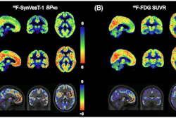 (A) Averaged parametric images of F-18 SynVesT-1 BPND values and (B) F-18 FDG SUVR (60–90 minutes) values overlaid on anatomical (T1) images in MNI space show group differences between behavioral variant frontotemporal dementia (top) and healthy controls (middle). The color scale represents (A) BPND and (B) SUVR values. On the bottom, average z-score maps were generated to visualize regional reductions in F-18 SynVesT-1 BPND and F-18 FDG SUVR in bvFTD relative to healthy controls. For each voxel, z-scores were calculated as z = (bvFTD−meanHC )/SDHC. Negative z-scores indicate lower synaptic density or glucose metabolism in the bvFTD compared with controls in the regions. BPND, non-displaceable binding potential; bvFTD, behavioral variant frontotemporal dementia; F-18 FDG, F-18 fluorodeoxyglucose; MNI, Montreal Neurological Institute; SUVR, standardized uptake value ratio.