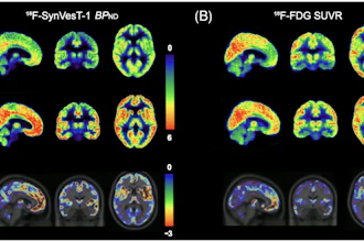 (A) Averaged parametric images of F-18 SynVesT-1 BPND values and (B) F-18 FDG SUVR (60–90 minutes) values overlaid on anatomical (T1) images in MNI space show group differences between behavioral variant frontotemporal dementia (top) and healthy controls (middle). The color scale represents (A) BPND and (B) SUVR values. On the bottom, average z-score maps were generated to visualize regional reductions in F-18 SynVesT-1 BPND and F-18 FDG SUVR in bvFTD relative to healthy controls. For each voxel, z-scores were calculated as z = (bvFTD−meanHC )/SDHC. Negative z-scores indicate lower synaptic density or glucose metabolism in the bvFTD compared with controls in the regions. BPND, non-displaceable binding potential; bvFTD, behavioral variant frontotemporal dementia; F-18 FDG, F-18 fluorodeoxyglucose; MNI, Montreal Neurological Institute; SUVR, standardized uptake value ratio.