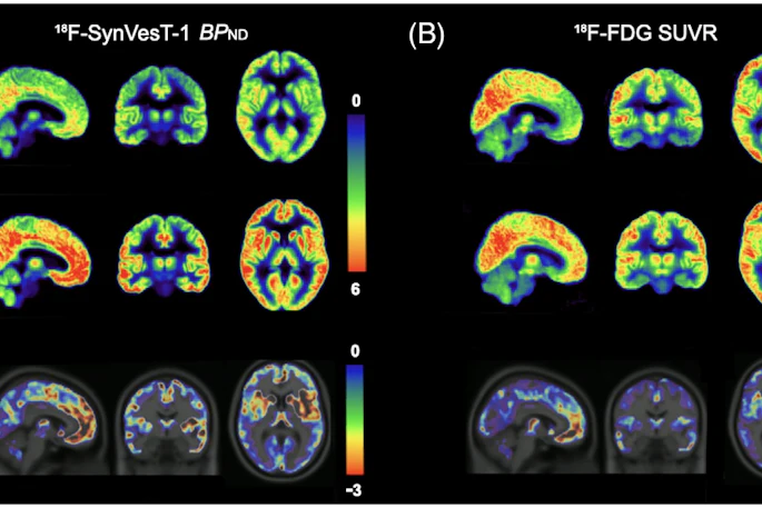 (A) Averaged parametric images of F-18 SynVesT-1 BPND values and (B) F-18 FDG SUVR (60–90 minutes) values overlaid on anatomical (T1) images in MNI space show group differences between behavioral variant frontotemporal dementia (top) and healthy controls (middle). The color scale represents (A) BPND and (B) SUVR values. On the bottom, average z-score maps were generated to visualize regional reductions in F-18 SynVesT-1 BPND and F-18 FDG SUVR in bvFTD relative to healthy controls. For each voxel, z-scores were calculated as z = (bvFTD−meanHC )/SDHC. Negative z-scores indicate lower synaptic density or glucose metabolism in the bvFTD compared with controls in the regions. BPND, non-displaceable binding potential; bvFTD, behavioral variant frontotemporal dementia; F-18 FDG, F-18 fluorodeoxyglucose; MNI, Montreal Neurological Institute; SUVR, standardized uptake value ratio.