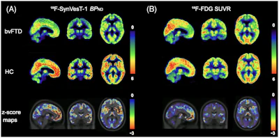 (A) Averaged parametric images of F-18 SynVesT-1 BPND values and (B) F-18 FDG SUVR (60–90 minutes) values overlaid on anatomical (T1) images in MNI space show group differences between behavioral variant frontotemporal dementia (top) and healthy controls (middle). The color scale represents (A) BPND and (B) SUVR values. On the bottom, average z-score maps were generated to visualize regional reductions in F-18 SynVesT-1 BPND and F-18 FDG SUVR in bvFTD relative to healthy controls. For each voxel, z-scores were calculated as z = (bvFTD−meanHC )/SDHC. Negative z-scores indicate lower synaptic density or glucose metabolism in the bvFTD compared with controls in the regions. BPND, non-displaceable binding potential; bvFTD, behavioral variant frontotemporal dementia; F-18 FDG, F-18 fluorodeoxyglucose; MNI, Montreal Neurological Institute; SUVR, standardized uptake value ratio.