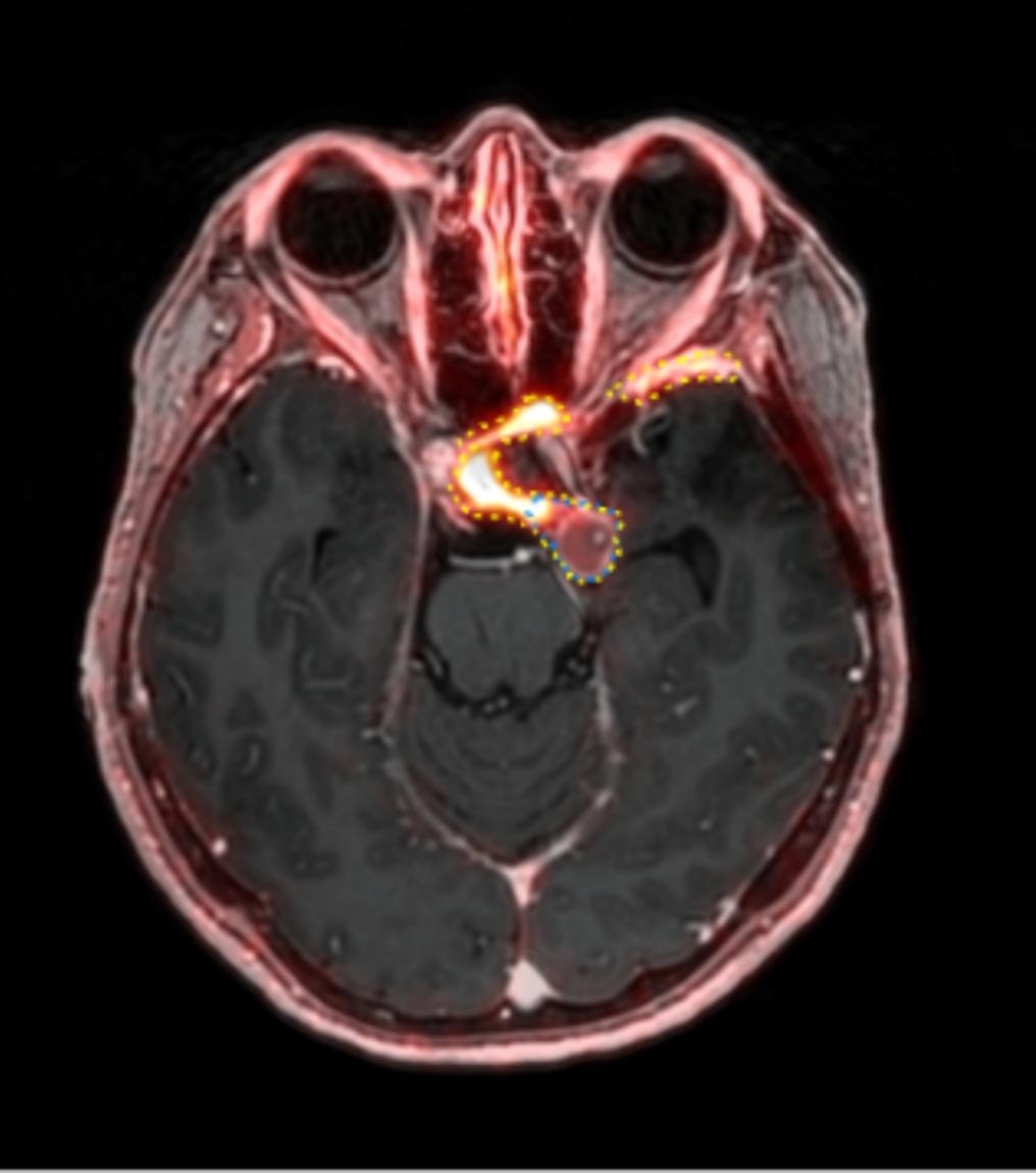 A 53-year-old patient (patient number four) with a recurrent pituitary adenoma with extension of a cystic component of disease to the medial temporal lobe apparent on MRI (contoured in blue), and extension of disease to the left sphenoid bone and orbital apex apparent on [68Ga]Ga-DOTA-TATE (contoured in yellow).