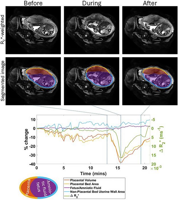 Uterine and placental changes during an example placental contraction. The top row shows axial MRI images at selected times points before, during and after a placental contraction (indicated by vertical lines on the graph below) with segmentations shown below. Changes in placental and non-placental volumes, wall areas and placental R2* (all measured across the whole volume of the uterus, not just the single slice shown) are plotted underneath. The legend indicates the colors used for the lines in the plots and the regions indicated in the segmentation.