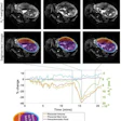 Uterine and placental changes during an example placental contraction. The top row shows axial MRI images at selected times points before, during and after a placental contraction (indicated by vertical lines on the graph below) with segmentations shown below. Changes in placental and non-placental volumes, wall areas and placental R2* (all measured across the whole volume of the uterus, not just the single slice shown) are plotted underneath. The legend indicates the colors used for the lines in the plots and the regions indicated in the segmentation.