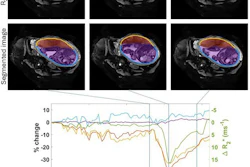 Uterine and placental changes during an example placental contraction. The top row shows axial MRI images at selected times points before, during and after a placental contraction (indicated by vertical lines on the graph below) with segmentations shown below. Changes in placental and non-placental volumes, wall areas and placental R2* (all measured across the whole volume of the uterus, not just the single slice shown) are plotted underneath. The legend indicates the colors used for the lines in the plots and the regions indicated in the segmentation.