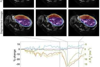 Uterine and placental changes during an example placental contraction. The top row shows axial MRI images at selected times points before, during and after a placental contraction (indicated by vertical lines on the graph below) with segmentations shown below. Changes in placental and non-placental volumes, wall areas and placental R2* (all measured across the whole volume of the uterus, not just the single slice shown) are plotted underneath. The legend indicates the colors used for the lines in the plots and the regions indicated in the segmentation.
