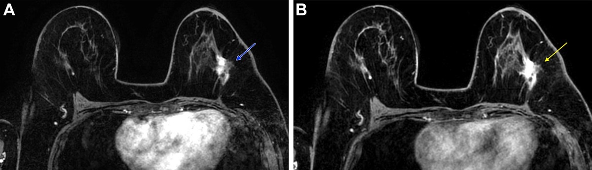 Post-neoadjuvant chemotherapy (NAC) MRI scans in a 66-year-old woman with invasive breast cancer show a lesion that appears fragmented in the first postcontrast axial T1-weighted image (arrow in A) but becomes more conspicuous and homogeneous in the last delayed phase (arrow in B). Despite these visual differences, response classification was identical between abbreviated and full diagnostic MRI. Pathologic analysis confirmed a partial response with residual invasive carcinoma.