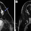 Post-neoadjuvant chemotherapy (NAC) MRI scans in a 66-year-old woman with invasive breast cancer show a lesion that appears fragmented in the first postcontrast axial T1-weighted image (arrow in A) but becomes more conspicuous and homogeneous in the last delayed phase (arrow in B). Despite these visual differences, response classification was identical between abbreviated and full diagnostic MRI. Pathologic analysis confirmed a partial response with residual invasive carcinoma.