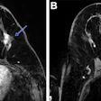 Post-neoadjuvant chemotherapy (NAC) MRI scans in a 66-year-old woman with invasive breast cancer show a lesion that appears fragmented in the first postcontrast axial T1-weighted image (arrow in A) but becomes more conspicuous and homogeneous in the last delayed phase (arrow in B). Despite these visual differences, response classification was identical between abbreviated and full diagnostic MRI. Pathologic analysis confirmed a partial response with residual invasive carcinoma.