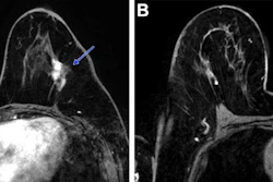 Post-neoadjuvant chemotherapy (NAC) MRI scans in a 66-year-old woman with invasive breast cancer show a lesion that appears fragmented in the first postcontrast axial T1-weighted image (arrow in A) but becomes more conspicuous and homogeneous in the last delayed phase (arrow in B). Despite these visual differences, response classification was identical between abbreviated and full diagnostic MRI. Pathologic analysis confirmed a partial response with residual invasive carcinoma.