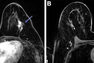 Post-neoadjuvant chemotherapy (NAC) MRI scans in a 66-year-old woman with invasive breast cancer show a lesion that appears fragmented in the first postcontrast axial T1-weighted image (arrow in A) but becomes more conspicuous and homogeneous in the last delayed phase (arrow in B). Despite these visual differences, response classification was identical between abbreviated and full diagnostic MRI. Pathologic analysis confirmed a partial response with residual invasive carcinoma.