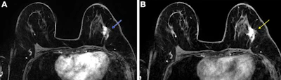 Post-neoadjuvant chemotherapy (NAC) MRI scans in a 66-year-old woman with invasive breast cancer show a lesion that appears fragmented in the first postcontrast axial T1-weighted image (arrow in A) but becomes more conspicuous and homogeneous in the last delayed phase (arrow in B). Despite these visual differences, response classification was identical between abbreviated and full diagnostic MRI. Pathologic analysis confirmed a partial response with residual invasive carcinoma.