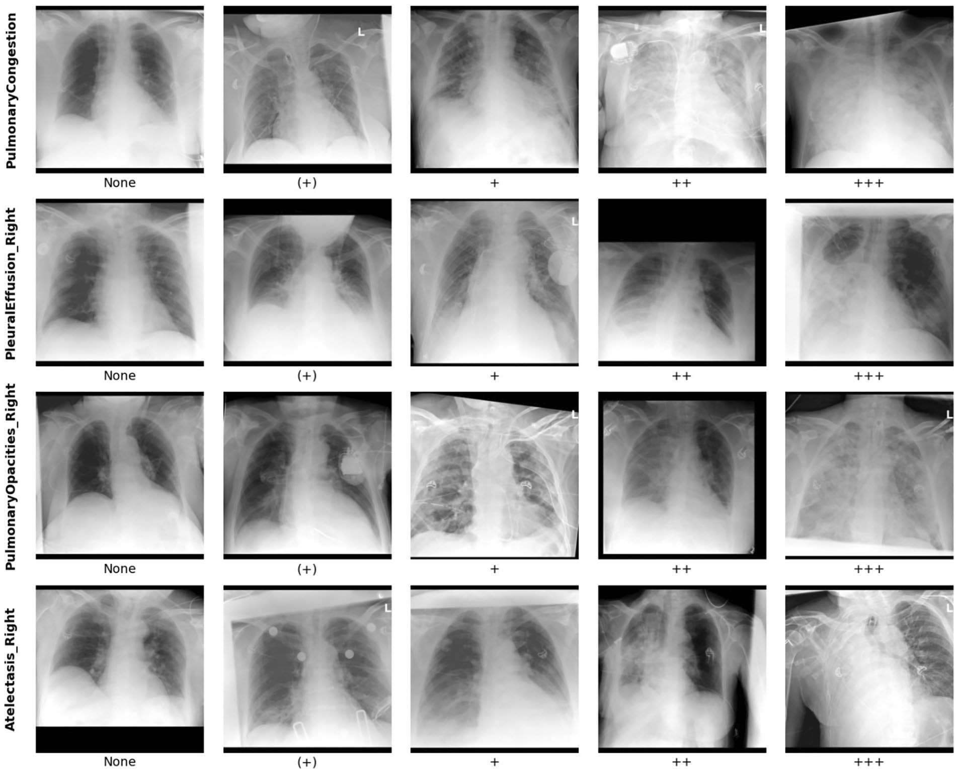 Example radiographs with different labels for 'pulmonary congestion,' 'pleural effusion,' 'pulmonary opacities,' and 'atelectasis.'