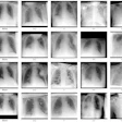 Example radiographs with different labels for 'pulmonary congestion,' 'pleural effusion,' 'pulmonary opacities,' and 'atelectasis.'