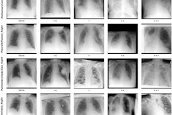 Example radiographs with different labels for 'pulmonary congestion,' 'pleural effusion,' 'pulmonary opacities,' and 'atelectasis.'