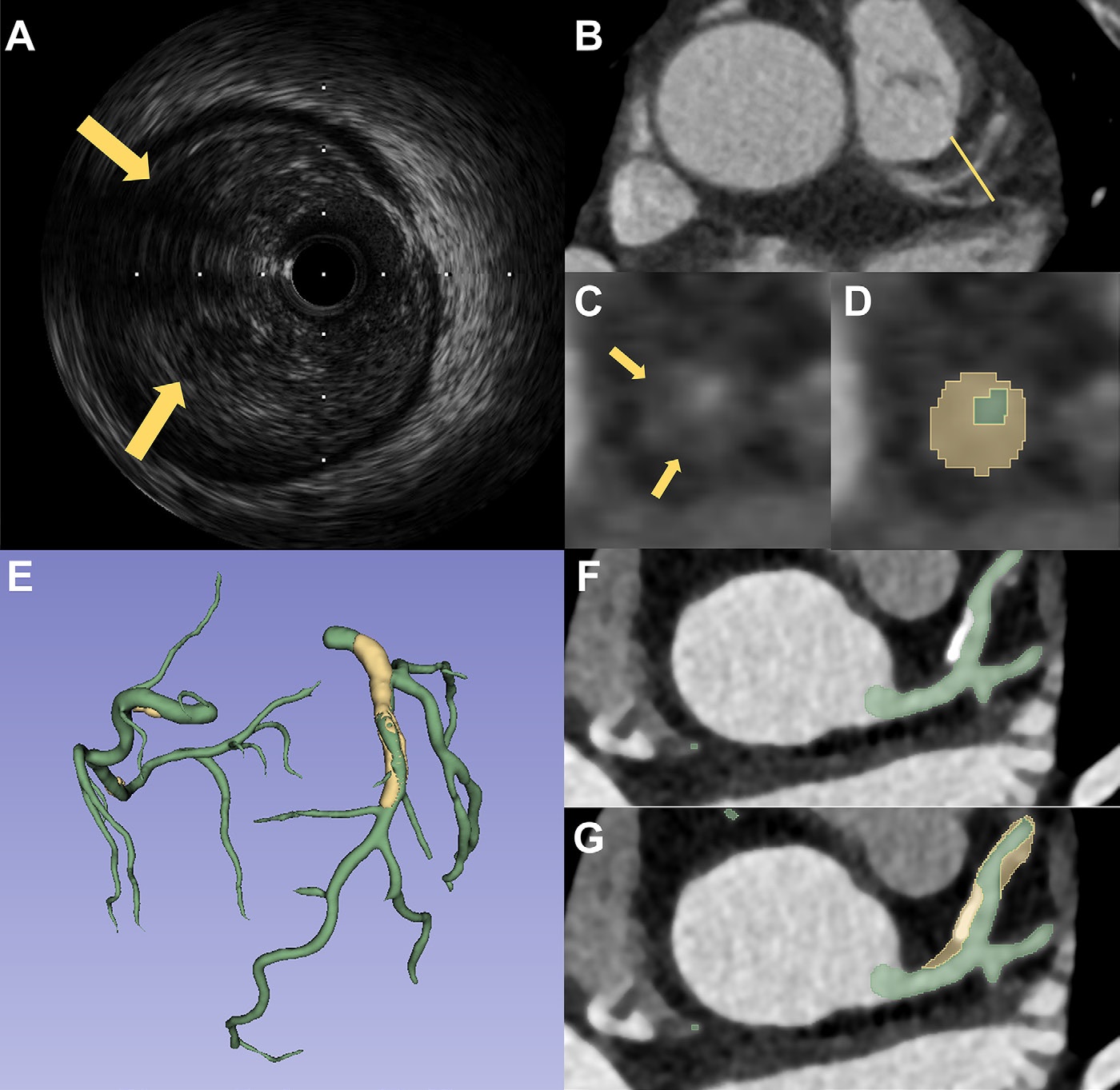 Two representative cases demonstrate the performance of PlaqueSegNet for coronary plaque segmentation. (A&ndash;D) Coronary CT angiography (CCTA) and intravascular US (IVUS) images in a 65-year-old male patient with chest pain for two months show plaque. (A) Cross-sectional IVUS image shows a lipid-rich plaque (hypoechoic, arrows). (B) Axial and (C) cross-sectional CCTA images show the same plaque (low-attenuation area, yellow line and arrows) in the proximal left anterior descending artery. (D) PlaqueSegNet segmentation of the noncalcified plaque (yellow shading) and coronary lumen (green shading) in the cross-sectional image. (E&ndash;G) CCTA images in a 57-year old female patient with chest pain for three months show multiple plaques. (E) Volume-rendered CCTA image of the coronary tree shows PlaqueSegNet plaque segmentation (yellow) in the right and left coronary arteries. (F, G) PlaqueSegNet segmentation delineates a mixed plaque (yellow shading) and coronary lumen (green shading) in the left main artery and proximal-to-mid left anterior descending artery.
