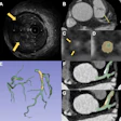 Two representative cases demonstrate the performance of PlaqueSegNet for coronary plaque segmentation. (A–D) Coronary CT angiography (CCTA) and intravascular US (IVUS) images in a 65-year-old male patient with chest pain for two months show plaque. (A) Cross-sectional IVUS image shows a lipid-rich plaque (hypoechoic, arrows). (B) Axial and (C) cross-sectional CCTA images show the same plaque (low-attenuation area, yellow line and arrows) in the proximal left anterior descending artery. (D) PlaqueSegNet segmentation of the noncalcified plaque (yellow shading) and coronary lumen (green shading) in the cross-sectional image. (E–G) CCTA images in a 57-year old female patient with chest pain for three months show multiple plaques. (E) Volume-rendered CCTA image of the coronary tree shows PlaqueSegNet plaque segmentation (yellow) in the right and left coronary arteries. (F, G) PlaqueSegNet segmentation delineates a mixed plaque (yellow shading) and coronary lumen (green shading) in the left main artery and proximal-to-mid left anterior descending artery.