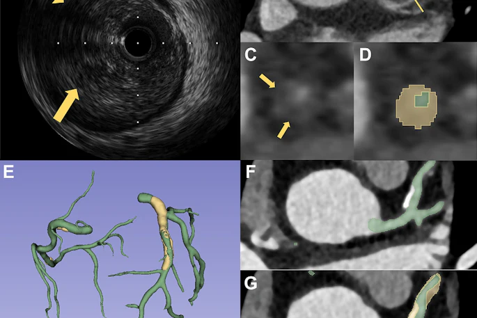 Two representative cases demonstrate the performance of PlaqueSegNet for coronary plaque segmentation. (A–D) Coronary CT angiography (CCTA) and intravascular US (IVUS) images in a 65-year-old male patient with chest pain for two months show plaque. (A) Cross-sectional IVUS image shows a lipid-rich plaque (hypoechoic, arrows). (B) Axial and (C) cross-sectional CCTA images show the same plaque (low-attenuation area, yellow line and arrows) in the proximal left anterior descending artery. (D) PlaqueSegNet segmentation of the noncalcified plaque (yellow shading) and coronary lumen (green shading) in the cross-sectional image. (E–G) CCTA images in a 57-year old female patient with chest pain for three months show multiple plaques. (E) Volume-rendered CCTA image of the coronary tree shows PlaqueSegNet plaque segmentation (yellow) in the right and left coronary arteries. (F, G) PlaqueSegNet segmentation delineates a mixed plaque (yellow shading) and coronary lumen (green shading) in the left main artery and proximal-to-mid left anterior descending artery.