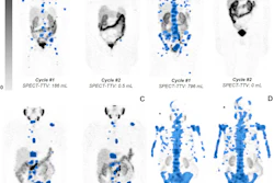 Quantification of total tumor volume (TTV) at lutetium-177 prostate-specific membrane antigen (PSMA)–617 SPECT/CT shows heterogeneous TTV responses between dose 1 (Cycle #1) and dose 2 (Cycle #2) in participants with metastatic castration-resistant prostate cancer. Posttherapy coronal attenuation-corrected noncontrast SPECT/CT maximum intensity projection images demonstrate (A) near-complete response in a 76-year-old man, (B) complete response in an 83-year-old man, (C) partial TTV reduction (not complete response) in a 69-year-old man, and (D) TTV increase (i.e. progressive disease) in a 74-year-old man. Blue-shaded regions represent semiautomatically segmented PSMA-avid tumor volume, with associated TTV values given at the bottom of each panel. The gradient bar shows standardized uptake value (SUV) from 0 to 5.