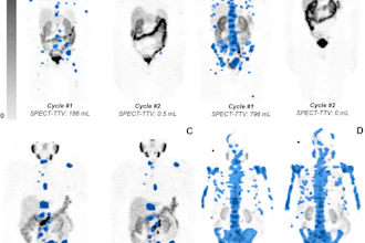 Quantification of total tumor volume (TTV) at lutetium-177 prostate-specific membrane antigen (PSMA)–617 SPECT/CT shows heterogeneous TTV responses between dose 1 (Cycle #1) and dose 2 (Cycle #2) in participants with metastatic castration-resistant prostate cancer. Posttherapy coronal attenuation-corrected noncontrast SPECT/CT maximum intensity projection images demonstrate (A) near-complete response in a 76-year-old man, (B) complete response in an 83-year-old man, (C) partial TTV reduction (not complete response) in a 69-year-old man, and (D) TTV increase (i.e. progressive disease) in a 74-year-old man. Blue-shaded regions represent semiautomatically segmented PSMA-avid tumor volume, with associated TTV values given at the bottom of each panel. The gradient bar shows standardized uptake value (SUV) from 0 to 5.