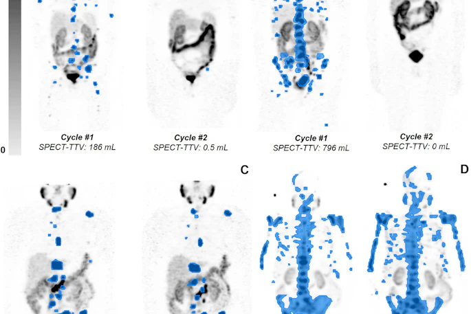 Quantification of total tumor volume (TTV) at lutetium-177 prostate-specific membrane antigen (PSMA)–617 SPECT/CT shows heterogeneous TTV responses between dose 1 (Cycle #1) and dose 2 (Cycle #2) in participants with metastatic castration-resistant prostate cancer. Posttherapy coronal attenuation-corrected noncontrast SPECT/CT maximum intensity projection images demonstrate (A) near-complete response in a 76-year-old man, (B) complete response in an 83-year-old man, (C) partial TTV reduction (not complete response) in a 69-year-old man, and (D) TTV increase (i.e. progressive disease) in a 74-year-old man. Blue-shaded regions represent semiautomatically segmented PSMA-avid tumor volume, with associated TTV values given at the bottom of each panel. The gradient bar shows standardized uptake value (SUV) from 0 to 5.