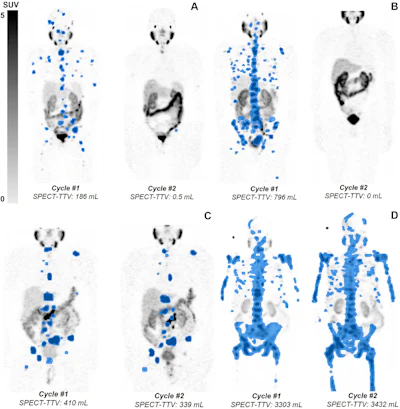 Quantification of total tumor volume (TTV) at lutetium-177 prostate-specific membrane antigen (PSMA)–617 SPECT/CT shows heterogeneous TTV responses between dose 1 (Cycle #1) and dose 2 (Cycle #2) in participants with metastatic castration-resistant prostate cancer. Posttherapy coronal attenuation-corrected noncontrast SPECT/CT maximum intensity projection images demonstrate (A) near-complete response in a 76-year-old man, (B) complete response in an 83-year-old man, (C) partial TTV reduction (not complete response) in a 69-year-old man, and (D) TTV increase (i.e. progressive disease) in a 74-year-old man. Blue-shaded regions represent semiautomatically segmented PSMA-avid tumor volume, with associated TTV values given at the bottom of each panel. The gradient bar shows standardized uptake value (SUV) from 0 to 5.