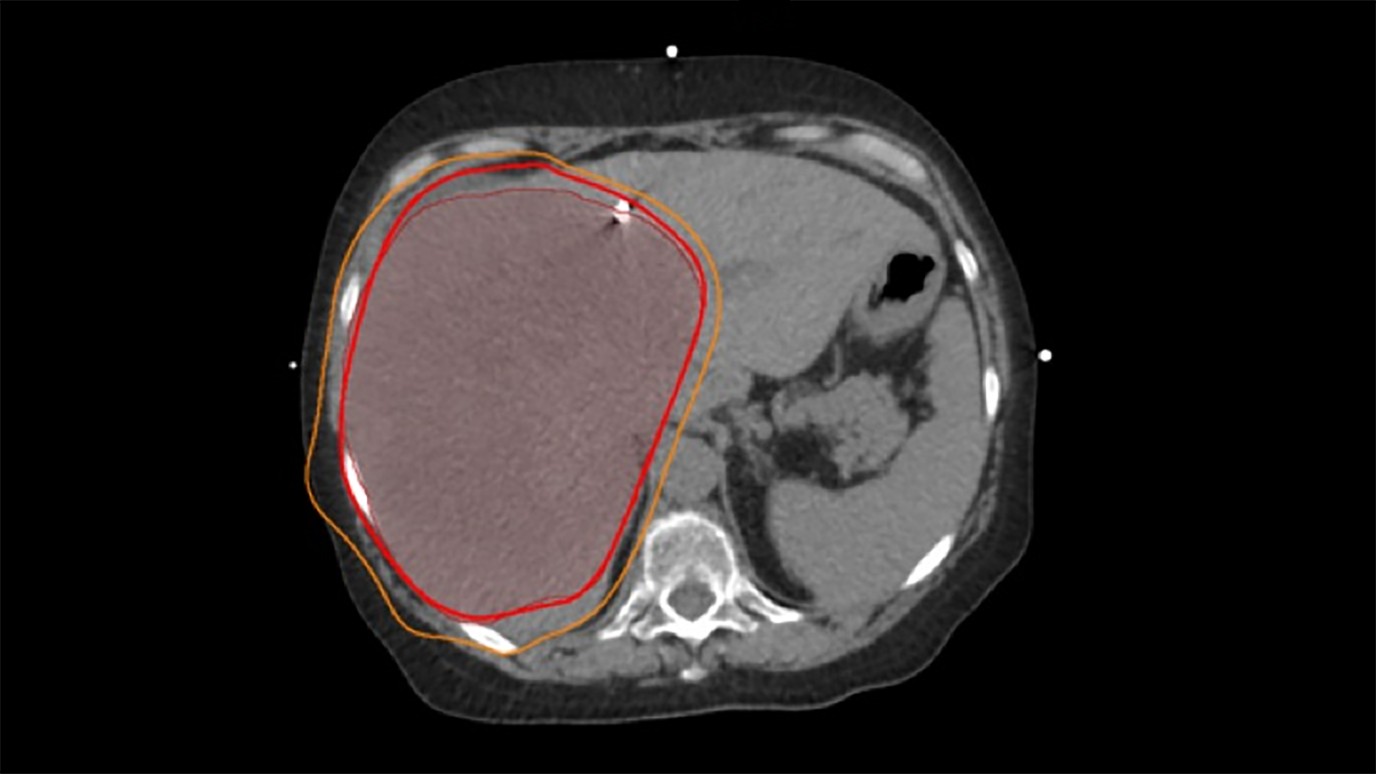 Sample radiation treatment plan demonstrating a 'supermassive' right liver tumor with planned radiation 'isodose lines' shown in bright red and orange.